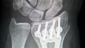 骨折（示意圖／翻攝自pixabay）