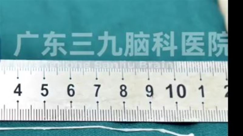 醫師進行開顱手術，夾出約10公分的活蟲。（圖／翻攝自廣州日報）