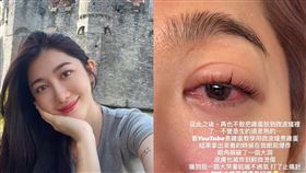 ▲王晴微波爐煮雞蛋，眼角膜被炸破了一個大洞。（圖／翻攝自王晴 IG）

