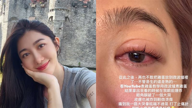 王晴微波爐煮雞蛋，眼角膜被炸破了一個大洞。（圖／翻攝自IG）