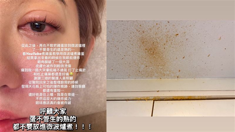 王晴微波爐煮雞蛋，眼角膜被炸破了一個大洞。（圖／翻攝自王晴 IG）