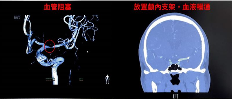 男子接受顱內血管支架置放手術，術後血管暢通，狀況穩定