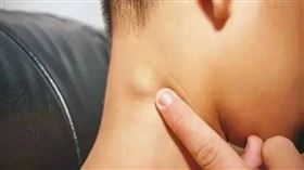 兒童長淋巴結較常見，因此很容易被忽視。（示意圖／翻攝自羊城晚報）