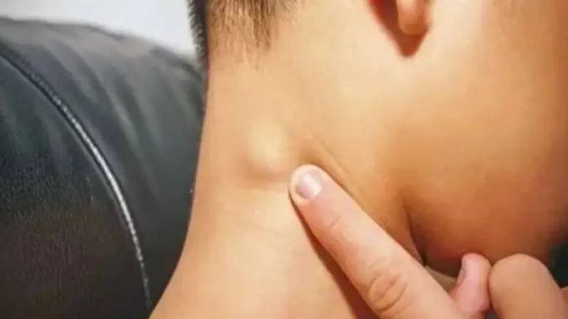 5歲童脖子長小疙瘩！醫曝：確診癌症晚期