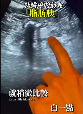 醫師表示在超音波檢查若發現胰臟特別亮白，代表有脂肪胰，要注意胰臟癌的風險。（圖／翻攝自錢政弘 胃腸肝膽科醫師粉專）