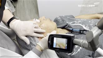 亞洲人皮膚色素困擾多　治療技術再進化