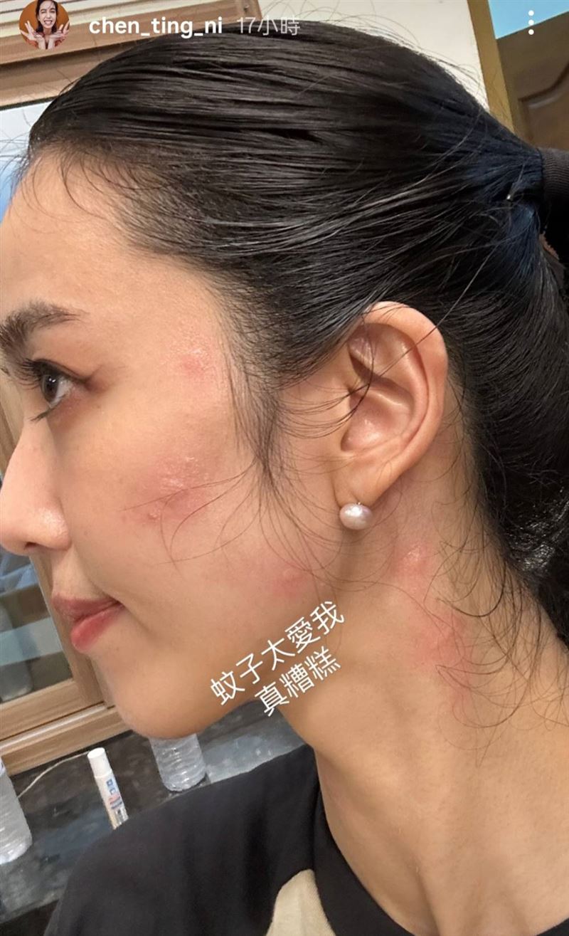 陳庭妮臉部被蚊子叮咬。(圖/翻攝自陳庭妮IG)
