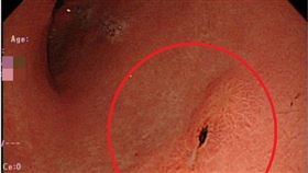 病人接受胃鏡檢查，發現邊緣不規則小潰瘍(紅圈處)，竟是罕見的印戒細胞型胃癌。（圖／大千綜合醫院提供） 