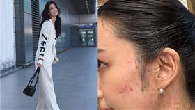 陳庭妮被蚊子叮。（圖／翻攝自陳庭妮IG）