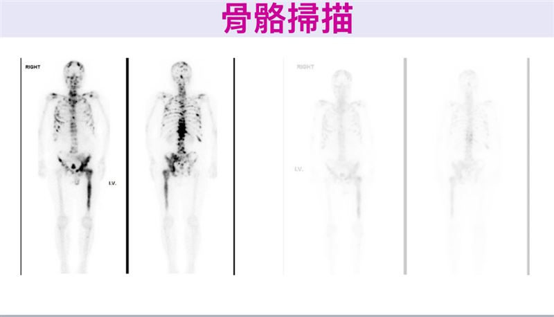 李男罹患攝護腺癌並骨轉移,治療後已有好轉。(圖/三總提供)