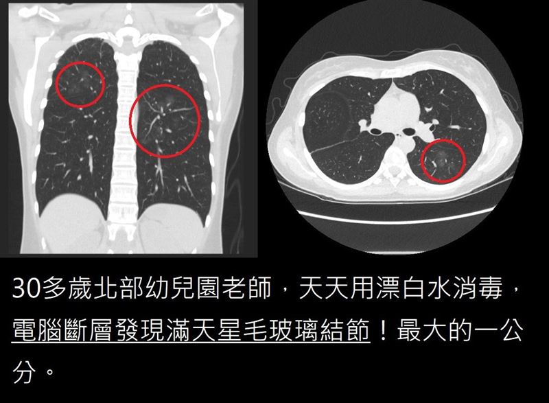 &nbsp;一名30多歲的幼兒園老師不抽煙也不咳嗽，檢查竟發現，肺部竟然有10顆肺結節。(圖/取自蘇一峰醫師的臉書)