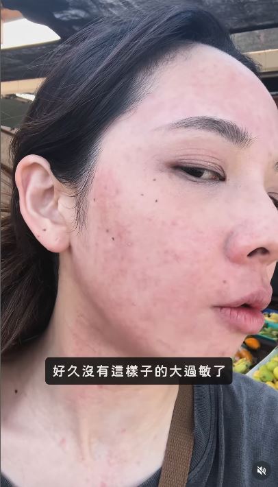 滴妹吃完藥半小時後紅腫狀況仍舊非常嚴重。(圖/翻攝自滴妹IG)