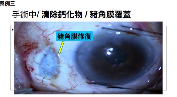 陳俊良醫師分享角膜修復個案。(圖/記者簡浩正攝影)
