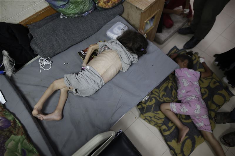 圖為資料照。2024年6月1日,3歲的阿雷(左)患有糖尿病、免疫系統較弱和營養不良,正在加薩中部的醫院治療。(圖/美聯社/達志影像)