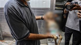 6月大女嬰被活活餓死！嚴重營養不良　「皮包骨」畫面震撼全球▲（圖／美聯社／達志影像）