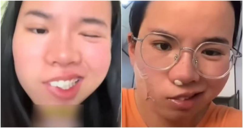 中國河南省一名25歲史姓女子開電風扇午睡,醒來後也嘴歪眼斜,被診斷出顏面神經麻痺。(圖/翻攝YouTube京新聞)