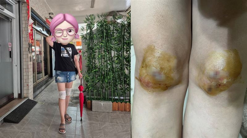 本土女星出事重摔！傷口發炎腫脹吃藥上工