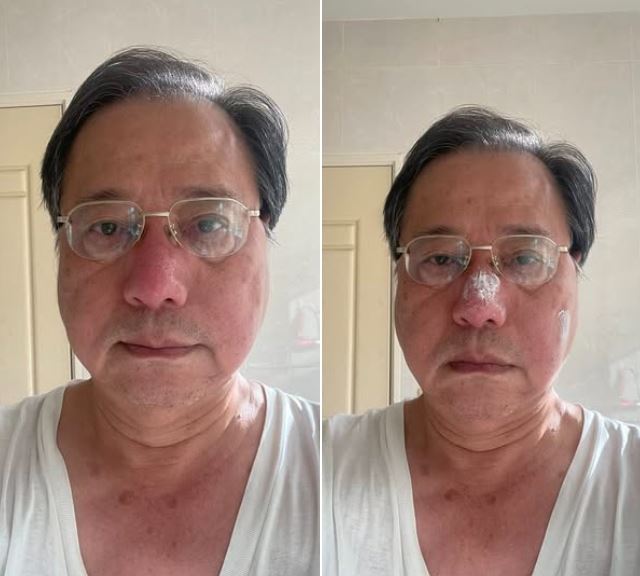 李來希PO出被蜜蜂螫到鼻樑的照片，自嘲「鼻樑腫脹猶似豬八戒，保全系統人臉辨識失敗」。（圖／翻攝自李來希臉書）