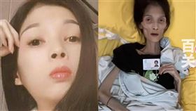 巧巧,胃萎縮（圖／翻攝自微博）