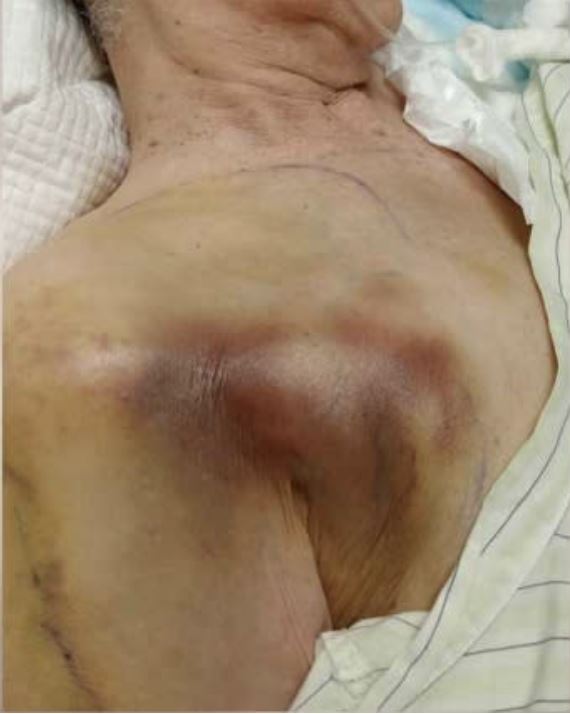 94歲陳姓阿嬤疑遭虐待,全身佈滿瘀青。(圖/翻攝畫面)