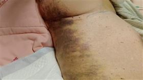 彰化94歲嬤疑遭虐待「全身瘀青」家屬心碎