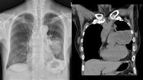 60歲婦不菸不酒不咳嗽！照X光驚見「7、8公分腫瘤」　蘇一峰：肺癌末期（圖／翻攝自蘇一峰臉書）