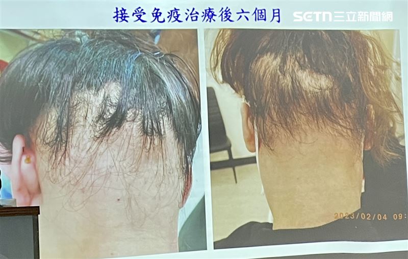 女子接受免疫治療，6個月後明顯好轉。（圖／記者蔣季容攝影）