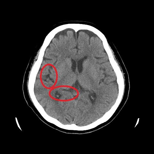 腦部核磁共振影像檢查出大腦顯著萎縮。（圖／翻攝畫面）