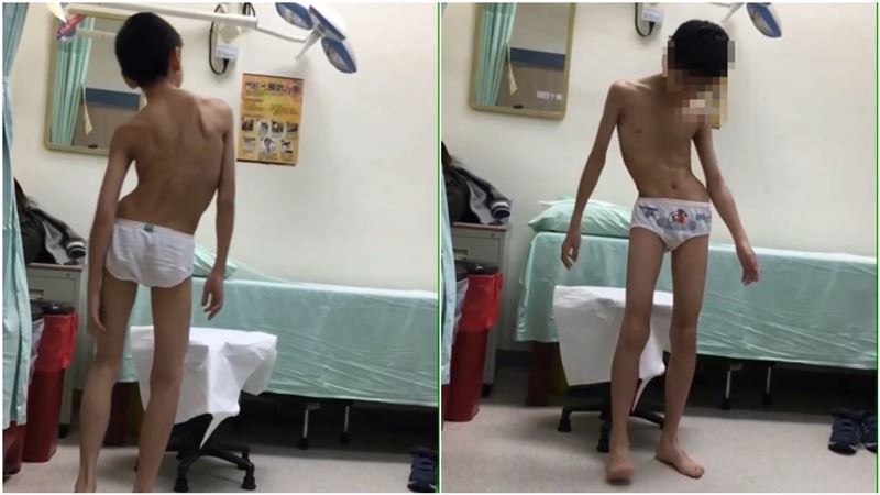 瓶蓋轉不開竟是病　12歲男「全身扭曲」