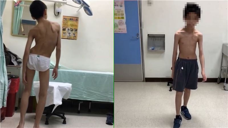 男童罹患「肌張力不全」全身扭曲,經治療後已恢復。(圖/台大醫院提供)