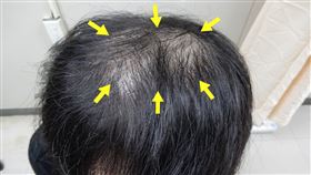 禿頭,梅毒,雄性禿,掉髮,台中,男子,主管（圖／翻攝畫面）