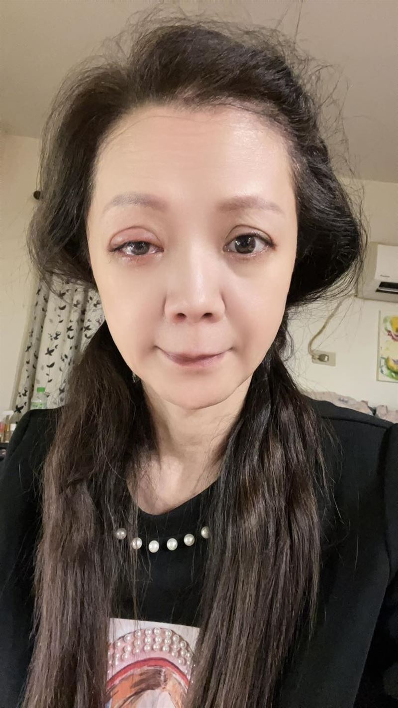 高欣欣把藥水點進眼睛,結果眼睛紅腫灼傷。(圖/翻攝自臉書)