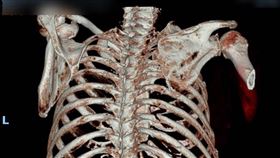 撿危物被撞肋骨狂斷，微創重拾自由呼吸。(圖/衛福部彰化醫院提供)