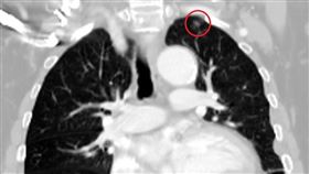 53歲男車禍「意外」發現極早期肺腺癌，0.9公分腫瘤，因禍得福(圖／光田醫院提供)