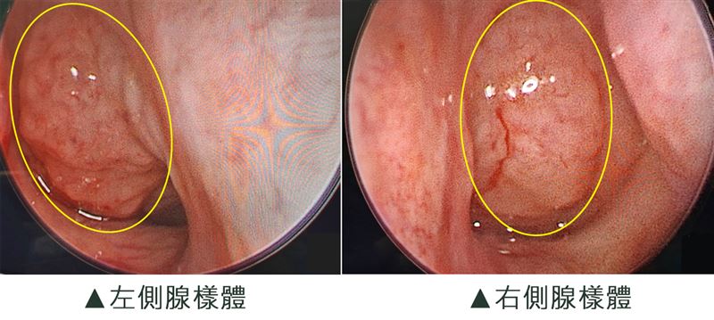 5歲男童因睡覺打呼、反覆感染中耳炎,醫師診斷他竟患有睡眠呼吸中止症。(圖/中港澄清提供)