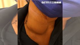 頸腫大如鴕鳥蛋險壓斷氣　68歲翁化療保命(圖/翻攝畫面)