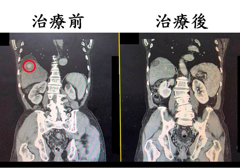 病人檢查發現有一將近3公分的肝腫瘤(紅圈處),接受治療後,腫瘤已消除。(圖/大千綜合醫院提供)