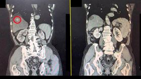 病人檢查發現有一將近3公分的肝腫瘤(紅圈處)，接受治療後，腫瘤已消除。（圖／大千綜合醫院提供） 