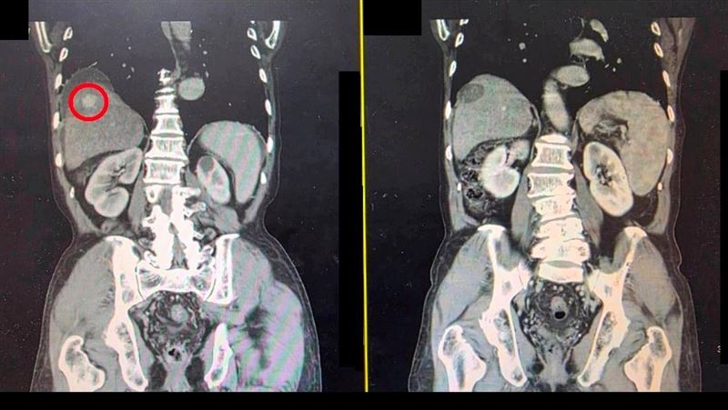 B肝不追蹤還喝酒 男腹脹驚見肝腫瘤纏身