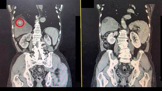 B肝不追蹤還喝酒　男腹脹驚見肝腫瘤纏身
