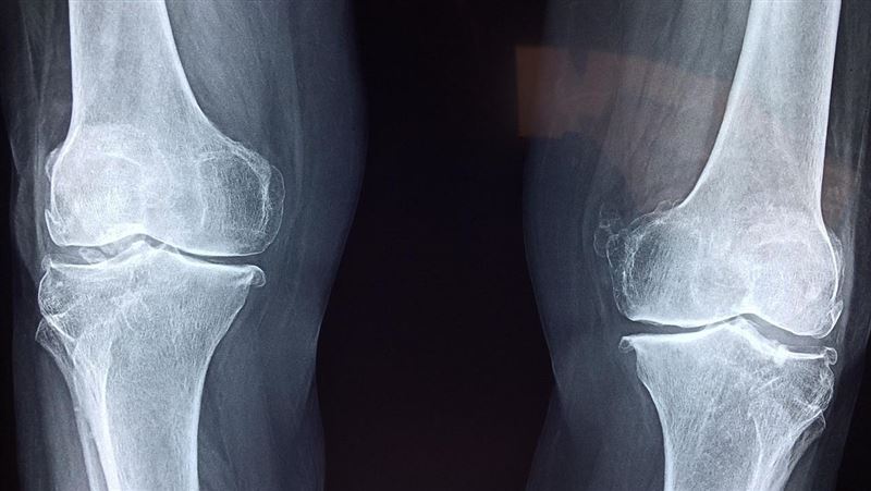 20歲女常曬太陽仍骨鬆 醫揭「1習慣」釀禍