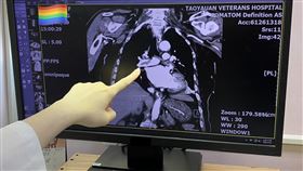 高齡族群當心！肺動脈栓塞難察覺注意症狀