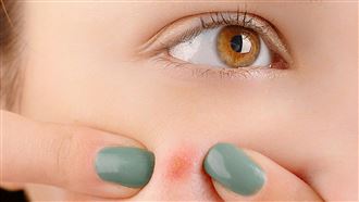 擠痘痘(示意圖／Pexels)