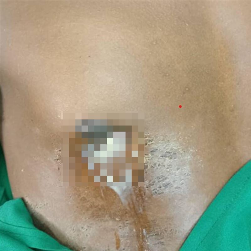44歲男子因為「乳頭流膿」到醫院就診。（圖／翻攝自Journal of Surgical Case Reports官網）