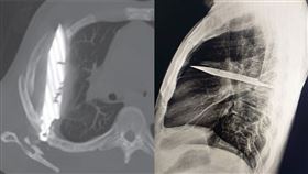 照Ｘ光發現一把刀插在胸腔8年。（圖／翻攝自Journal of Surgical Case Reports官網）