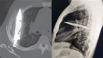 44歲男乳頭流膿　X光驚見「刀插胸腔8年」