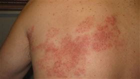皮膚長痘痘，前胸蔓延到後背，「皮蛇」帶狀疱疹 (示意圖／林新醫院提供)