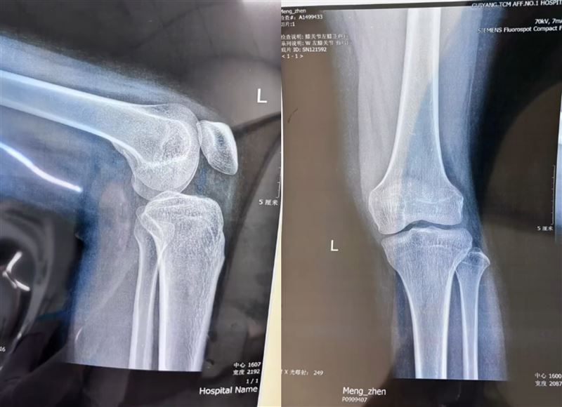妹子被踹下山谷後，就醫發現腿部骨折。（圖／翻攝自微博）