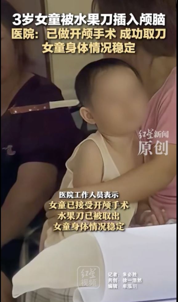 水果刀插進女童頭顱，緊急手術後在恢復中。（圖／翻攝自微博）