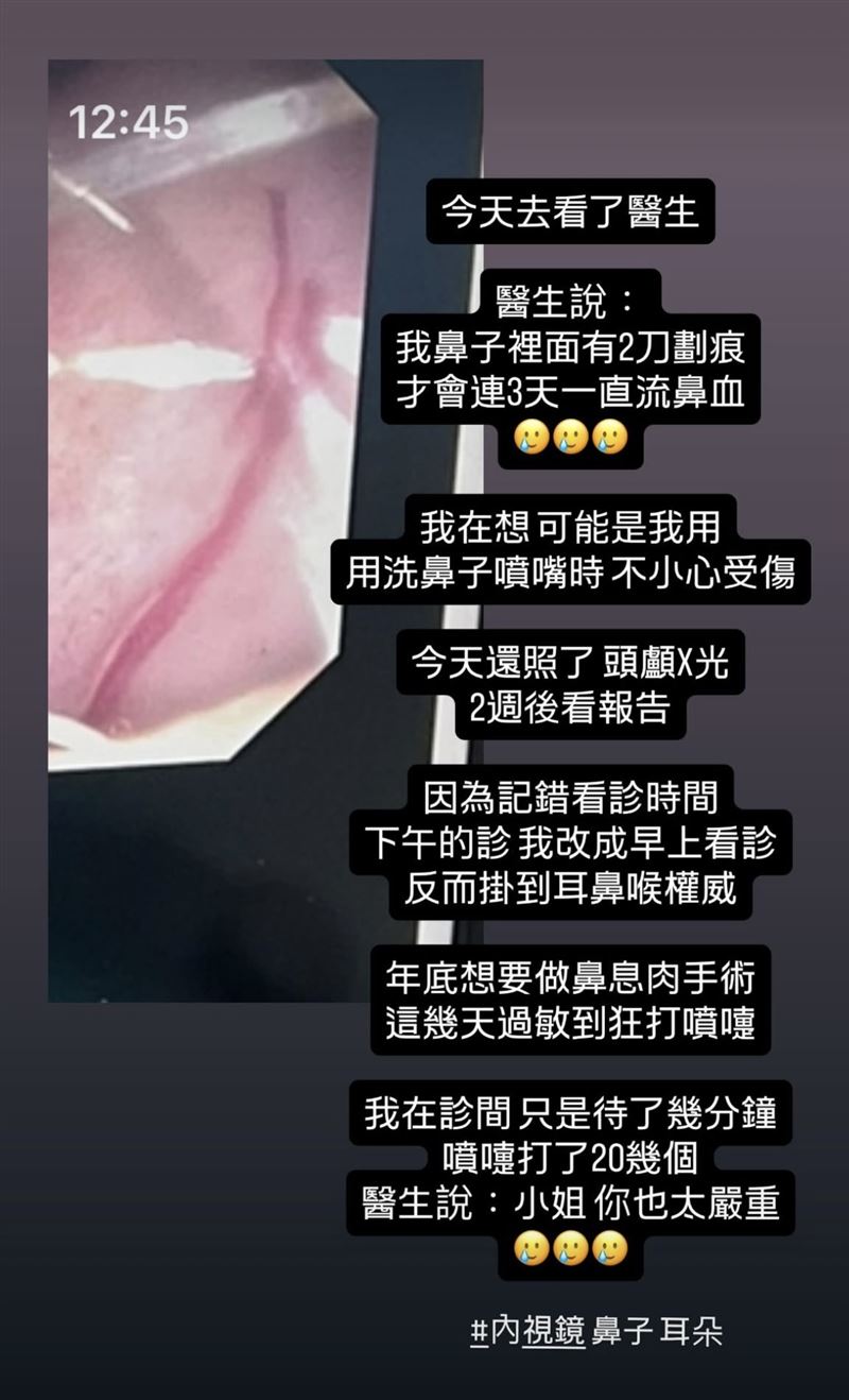 米可白分享鼻子內視鏡畫面。（圖／翻攝自米可白臉書）